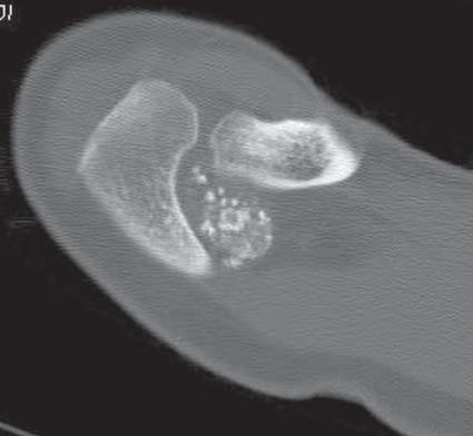 Multilinear computerised tomography in bone tumors with calcifications in soft tissues, based on two