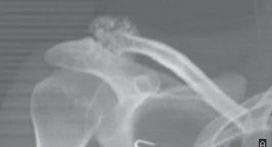 Exostoses multipices rekonstrukcja VRT 3 D okolica prawego barku Pic. 2. Patient HJ.