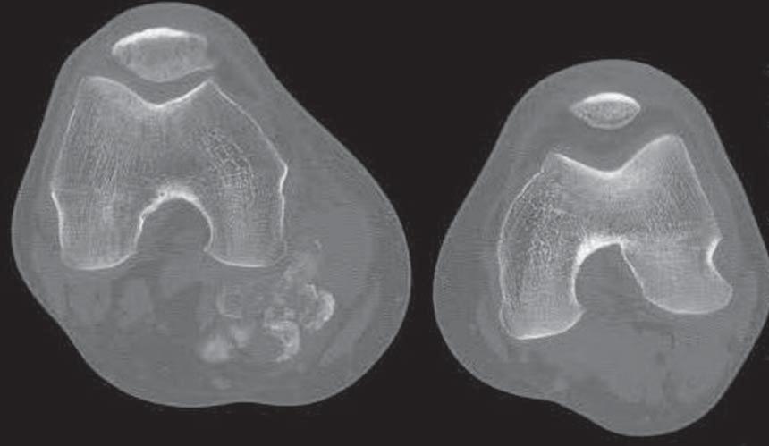 Exostoses multipices - rekonstrukcja VRT transparentna okolica prawego barku Pic. 4.