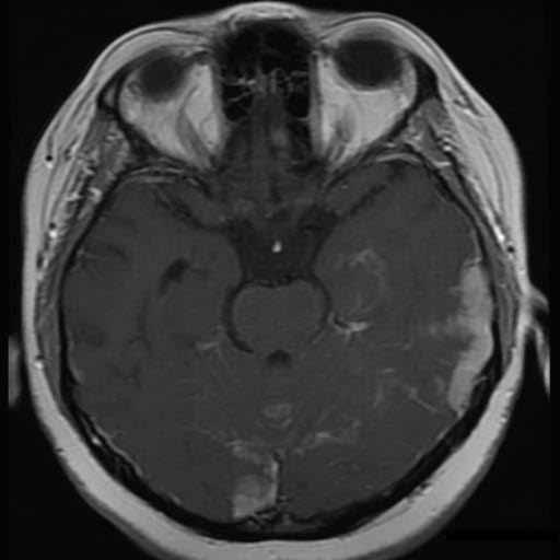 Halina Rudnicka, Diagnostyka kliniczna w neuroonkologii Rycina 1. Linijne wzmocnienie opon mózgowo-rdzeniowych w obrazie MR Rycina 2.