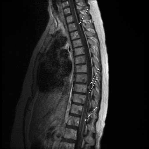 Wystąpienie objawów neurologicznych jest następstwem uszkodzenia struktur układu nerwowego wskutek odpowiedzi immunologicznej wywołanej ekspresją w tkance nowotworowej antygenów onkoneuronalnych, to