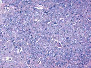 Aktualizacje w diagnostyce i leczenie GI-PDNEC Anna Koumarianou et al. Tabela I (cd.).