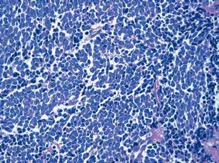 Differences between pulmonary and extrapulmonary PDNEC Analogi somatostatyny Nie mają zastosowania, gdyż w komórkach nowotworowych nie dochodzi do ekspresji receptorów somatostatynowych.