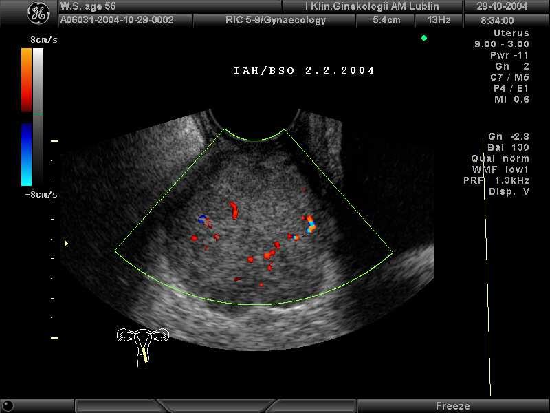 endometrium u chorej w 8 miesięcy po hysterektomii z przydatkami.