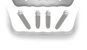 Oryginalne Koncepcja leczenia All-on-4. 1 proteza stała Tymczasowa odbudowa pełnego łuku w dniu zabiegu chirurgicznego.* 4 implanty Dwa proste z przodu, dwa pochylone z tyłu.