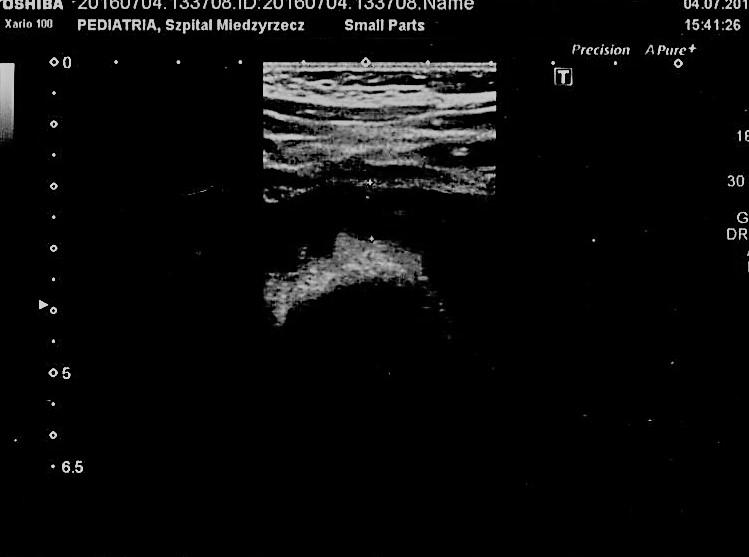 wodonercze nerki prawej > 10mm AP * dalsza diagnostyka (USG, CUM,