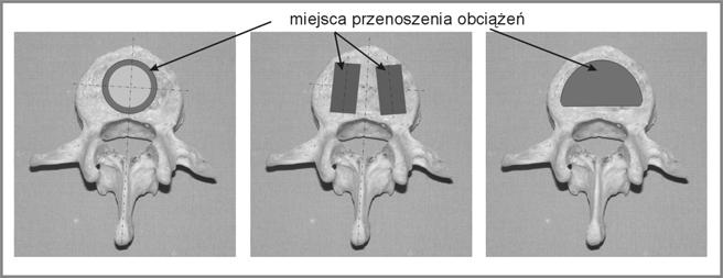 Obszary obciążane blaszek granicznych w zależności od typu stabilizacji międzytrzonowej: a) dla