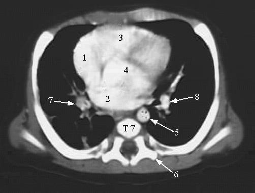 1. Prawy przedsionek. 2. Lewy przedsionek. 3. Prawa komora. 4.