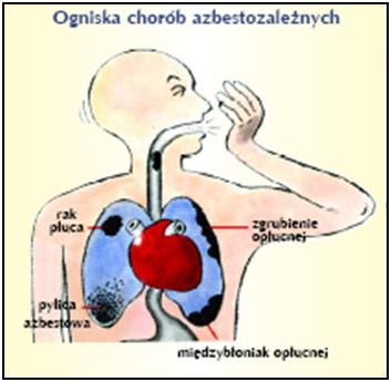 a) pylicy azbestowej (azbestozy), b) łagodnych zmian opłucnowych, c) raka płuca, d) międzybłoniaków; Zdjęcie 7 Ogniska chorób azbestozależnych Pylica azbestowa (azbestoza) to rodzaj pylicy płuc