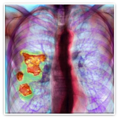 Zdjęcie 8 Zdjęcie rentgenowskie płuc osoby chorej na abestozę Zmiany opłucnowe występują już przy niewielkim narażeniu na włókna azbestowe.