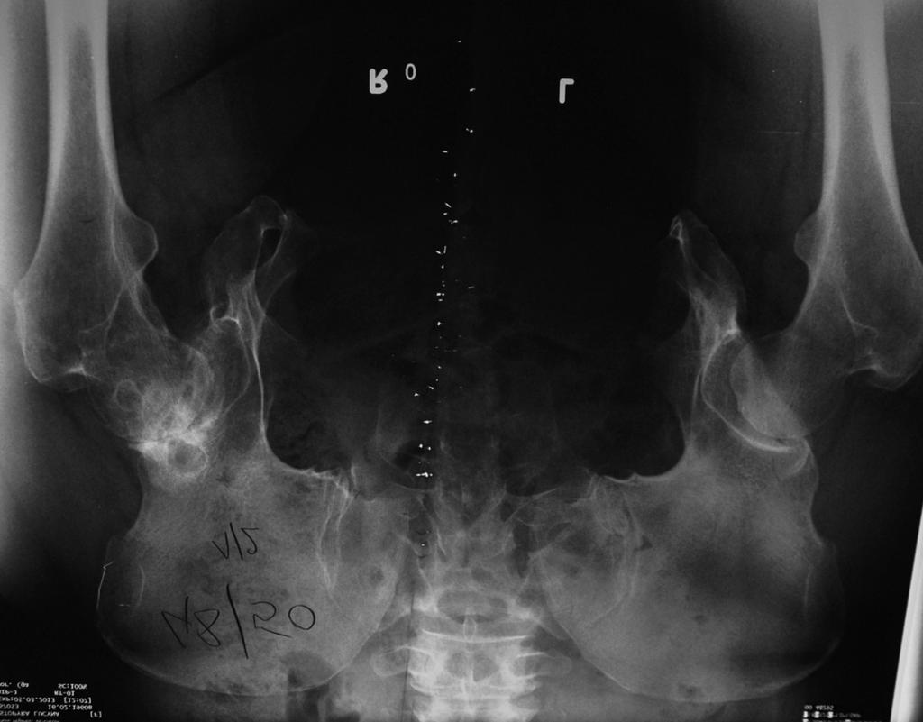 Drobniewski M. et al. Treatment of Degenerative Hip Joint Disease Ryc. 1. L.S. (32068K), RTG miednicy zaawansowane zmiany zwyrodnieniowe prawego stawu biodrowego, rozejście spojenia łonowego Fig.1 L.