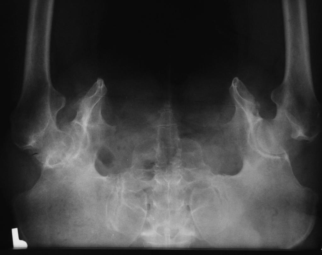 Drobniewski M. et al. Treatment of Degenerative Hip Joint Disease Ryc. 3 B.K.