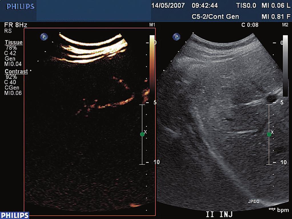 Ultrasonografia z zastosowaniem środka kontrastującego SonoVue w diagnostyce i różnicowaniu łagodnych w wątrobie Ryc. 2a.. Faza wczesna tętnicza widoczny promienisty układ naczyń. Ryc. 2b.
