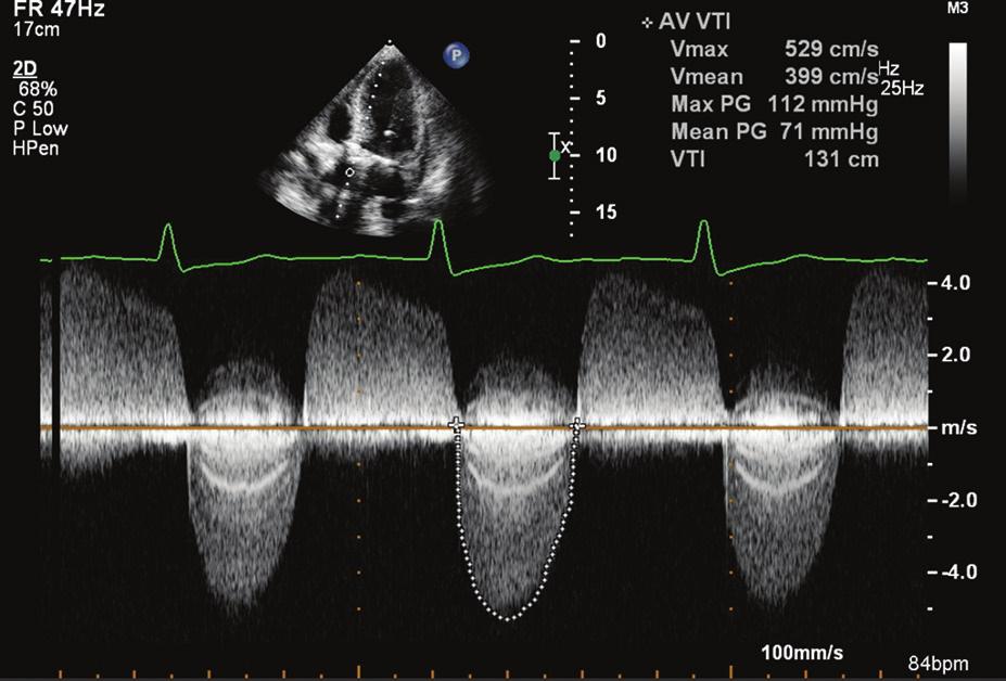 Folia Cardiologica 2015, tom 10, nr 3 (ACC/AHA) z 2014 roku, dotyczących postępowania z chorymi z wadami serca, przedstawiono cztery następujące stadia zaawansowania AS: stadium A pacjenci z grupy