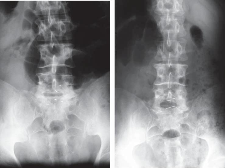 Complications and difficulties in treatment of degenerative disc disease in lumbar spine with interspinous distractor 87 Distractor implantation is the least invasive method of surgical treatment,