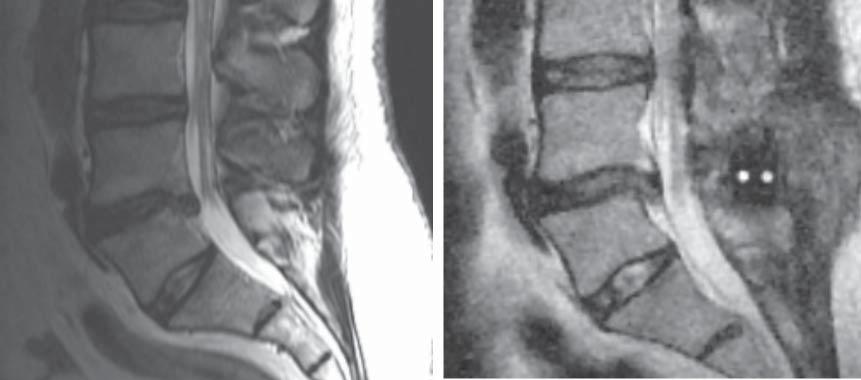 Complications and difficulties in treatment of degenerative disc disease in lumbar spine with interspinous distractor 89 Over 70% of patients expressed satisfaction with the treatment and reported a