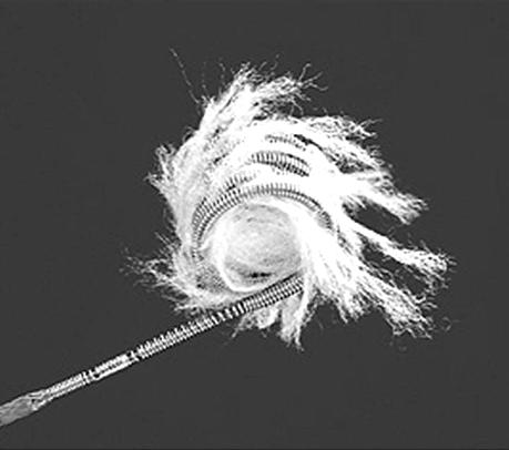 Dodatkowo d³ugotrwa³y istotny hemodynamicznie przeciek lewo- -prawy doprowadza do nadciœnienia p³ucnego, a równie inne obci¹ enia pozakardiologiczne mog¹ zwiêkszaæ ryzyko operacji.