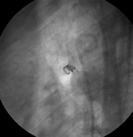 Ryc. 6. Odczepialny koil implantowany do w¹skiego przewodu têtniczego Fig. 6. Small PDA detachable coil implanted LVDD z œrednio 60,5 mm (±0,94) do 54,4 mm (±0,47) po miesi¹cu od zabiegu.