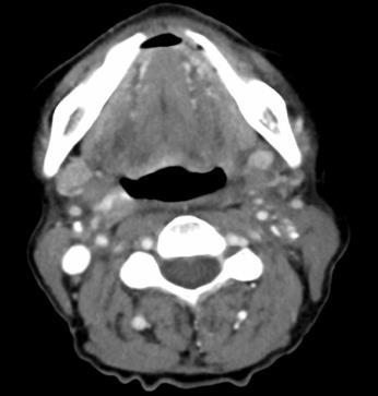 not detectable SALVAGE SURGERY Hist-pat +3/5 nodes