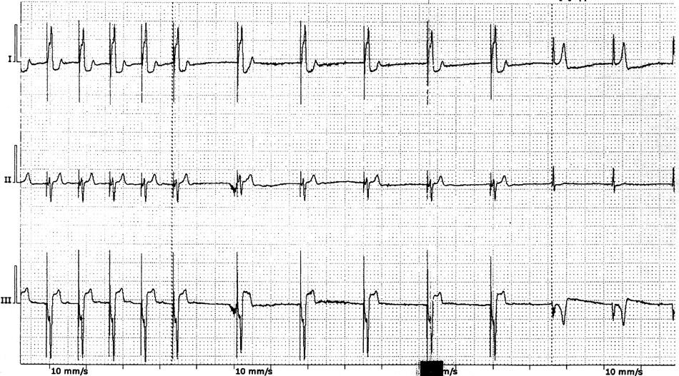 Roman Steckiewicz et al. Rycina 3. Zwolnienie rytmu stymulacji z 65/min do 35/min. Po 1071. sekundzie pojawił się rytm zastępczy z łącza przedsionkowo-komorowego o częstości ok. 36/min (QRS 105 ms).