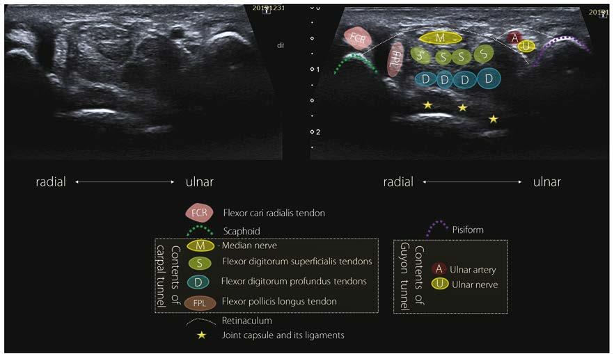 Struktury anatomiczne ocenianie podczas badania ultrasonograficznego dłoniowej części nadgarstka cztery ścięgna zginacza głębokiego palców (flexor digitorum profundus, FDP), ścięgno zginacza długiego