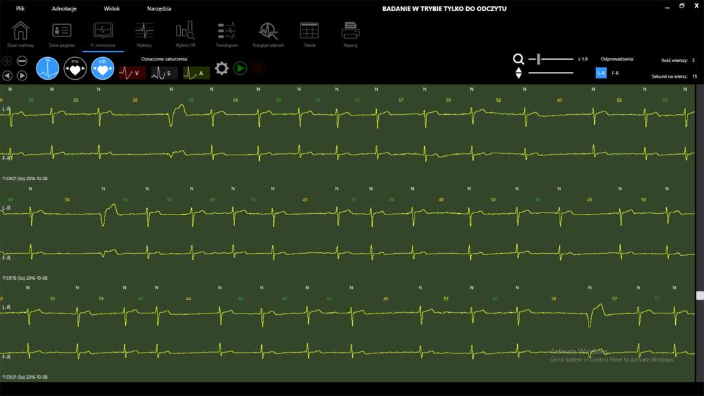 Przykład zapisu EKG