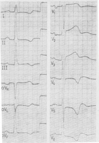 W wykonanym badaniu EKG (obraz poniżej) widoczne są zmiany charakterystyczne dla akromegalii: