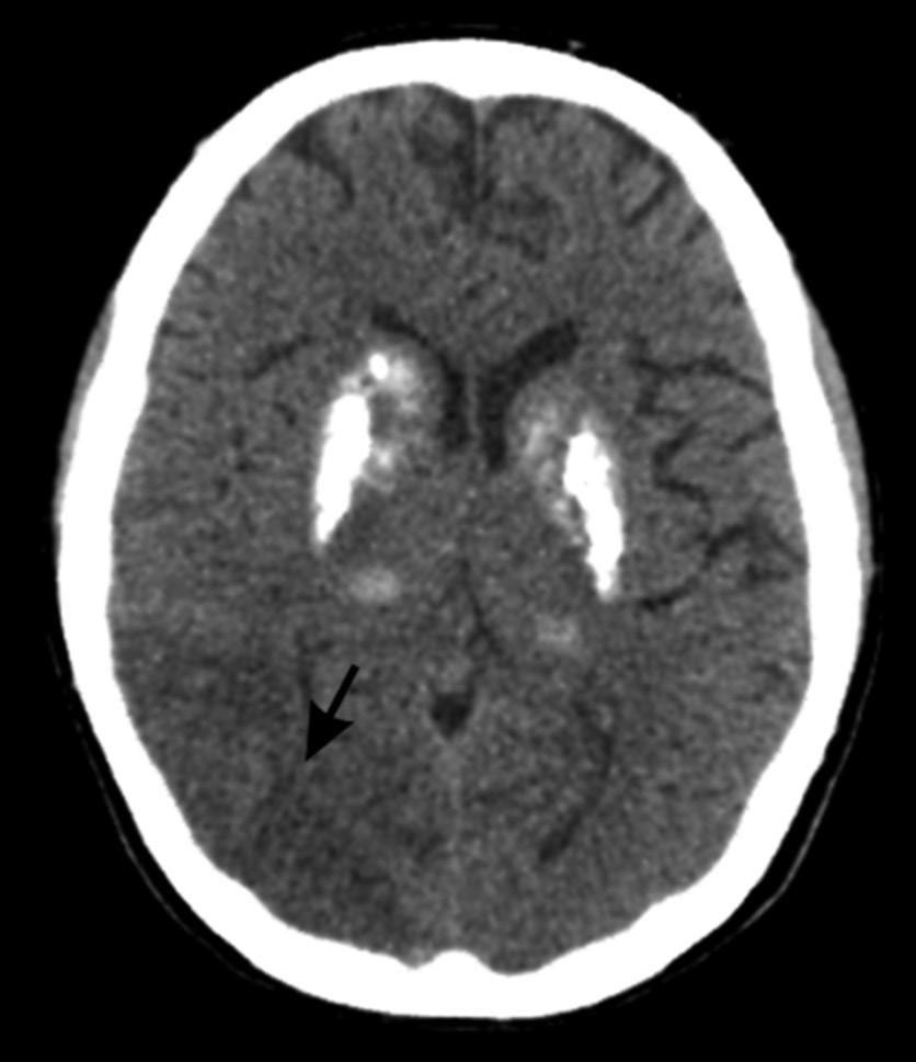 Rzadkie genetycznie uwarunkowane mikroangiopatie w praktyce lekarza neurologa MELAS to jedna z najczęstszych chorób mitochondrialnych, charakteryzująca się występowaniem objawów podobnych do objawów