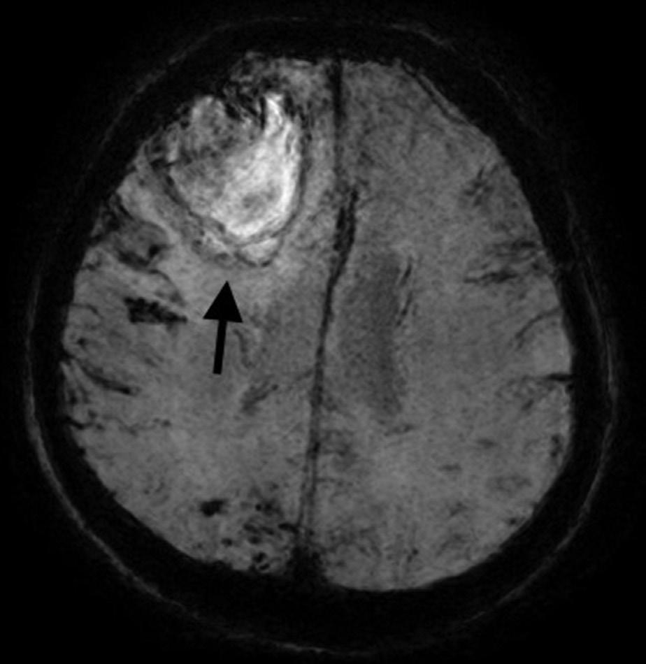 Rzadkie genetycznie uwarunkowane mikroangiopatie w praktyce lekarza neurologa Pewna mózgowa angiopatia amyloidowa Prawdopodobna mózgowa angiopatia amyloidowa z potwierdzeniem w badaniu