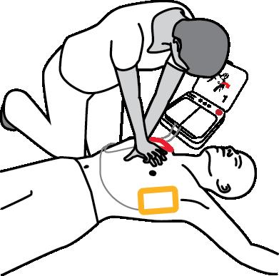 Rozdział 4 Użytkowanie defibrylatora 13 Defibrylator wyemituje instrukcje, aby rozpocząć uciskanie klatki piersiowej.