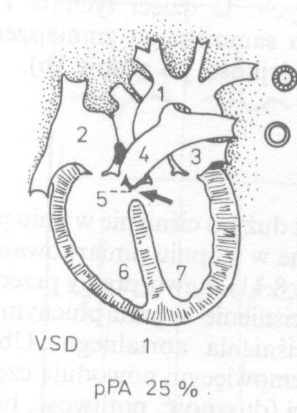 1. W małym VSD: mały naczyniowy opór płuc, światło tętniczek płucnych szerokie.