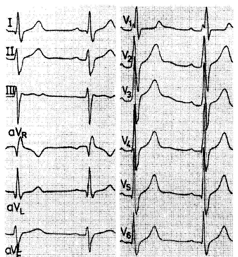 EKG:W istotnym ubytku widoczne są