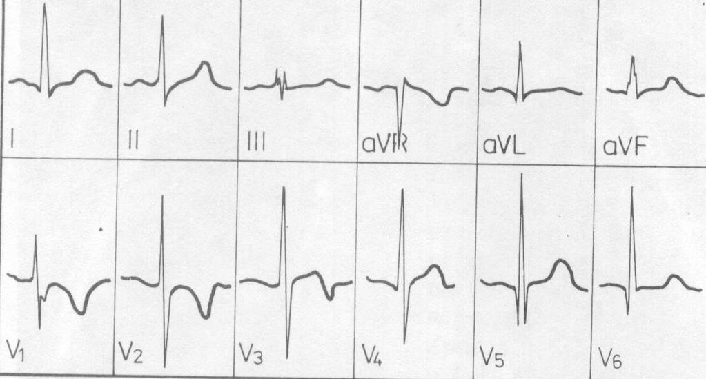 PDA badania pomocnicze EKG: W małym prawidłowy.