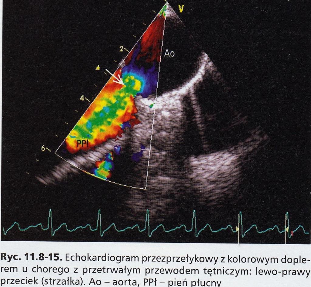 Badanie echokardiograficzne. Badanie to potwierdza rozpoznanie wady serca.