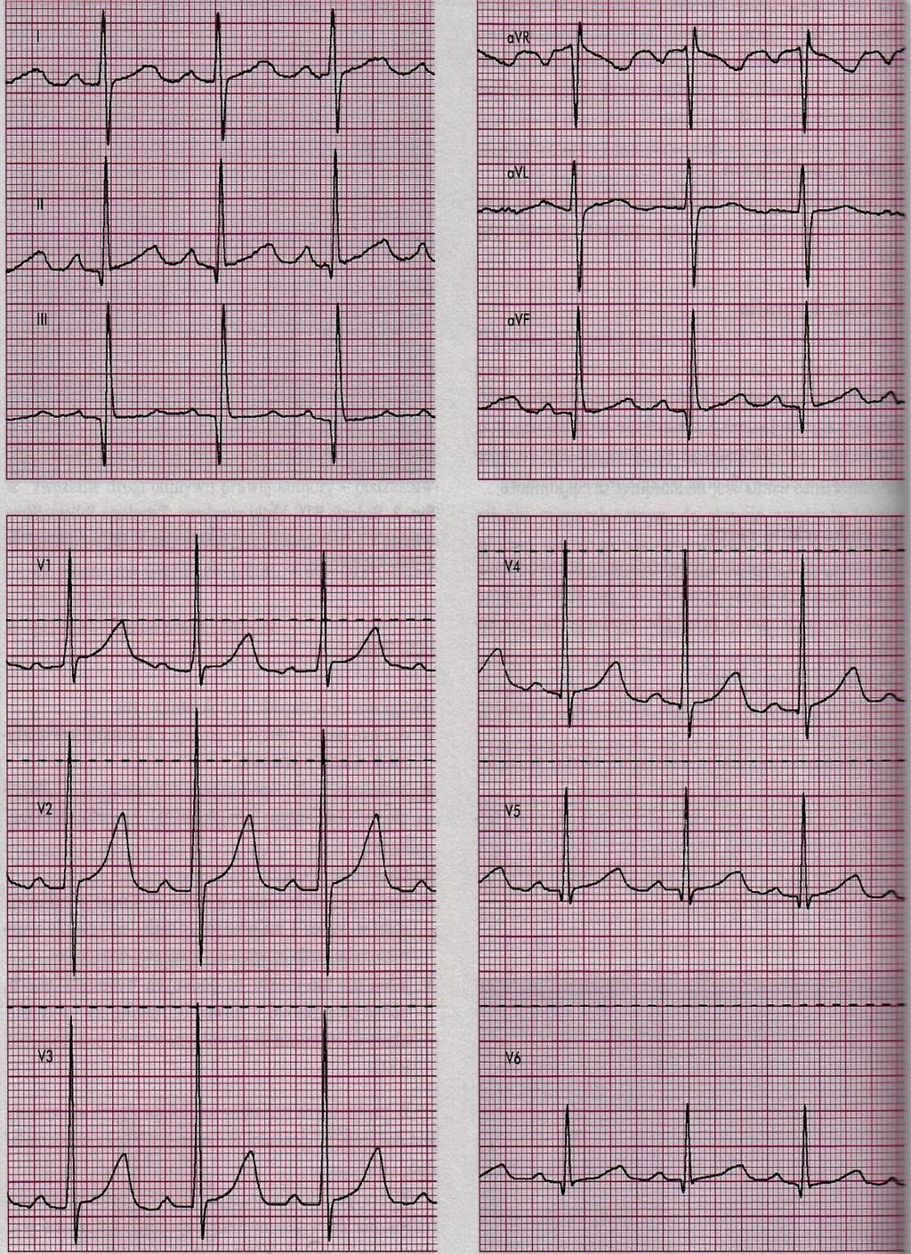 EKG: RZM 140/min. Cechy przerostu prawej komory : M. Gąsior, M. Hawranek, L.