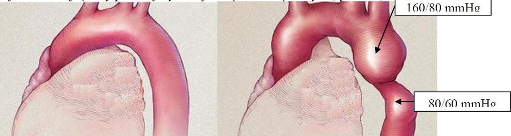 Definicja: Zwężenie cieśni aorty występuje na wysokości fizjologicznego zwężenia aorty między odejściem lewej tętnicy podobojczykowej a więzadłem tętniczym U dorosłych występuje jako izolowana.
