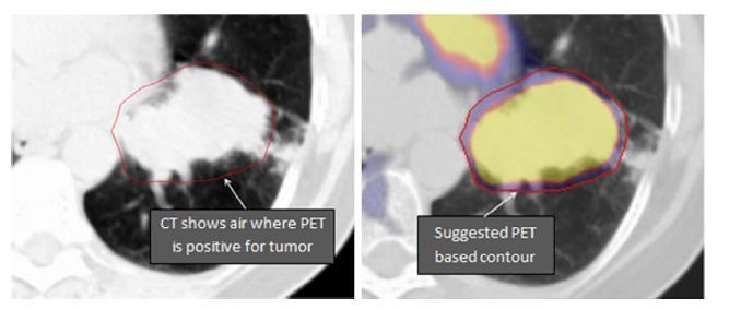 GTV: na podstawie PET-CT 2.