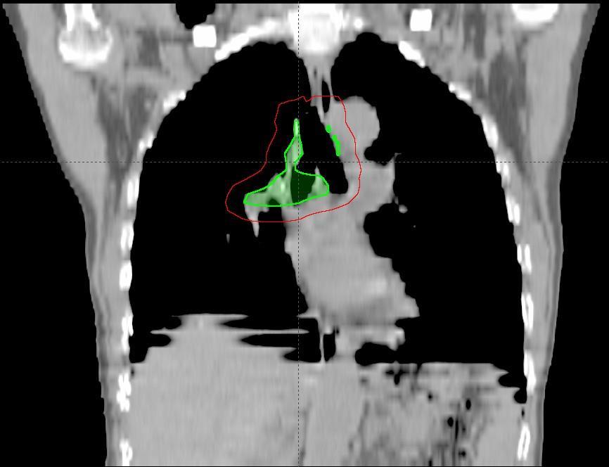 Radioterapia pooperacyjna Obszar