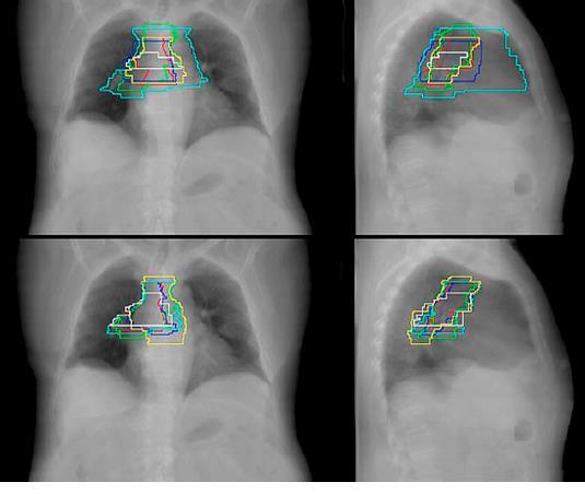 Radioterapia pooperacyjna Różnice w konturowaniu