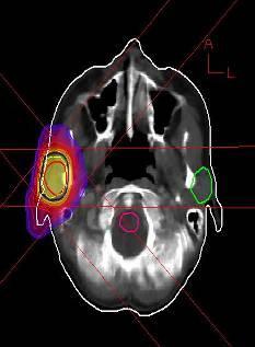 Comparison of Treatment Plans Glandula parotid cancer Photons 2 fields Photons 5 fields