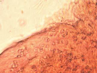 Application of autologous chondrocytes suspension in fibrin glue for the treatment of cartilage defects of knee joint 45 MATERIALS AND METHODS Researches on application of the suspension of