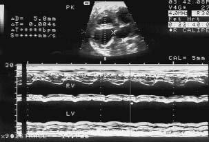 neonates** walwuloplastyka*** 4 valvuloplasty 4 neonates*** Zgon 1 One neonatal death Dom 1 One neonate discharged home Zgon 1*** One neonatal death*** Dom 3 3 neonates discharged home * czas zgonu