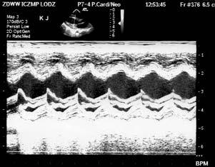 Respondek-Liberska M., Szaflik K., Krasomski G. et al. Cardiac intervention in aortic stenosis Pol. Przegl. Kardiol., 2006, 8, 2, 113-118 RYCINA 4. IGURE 4.
