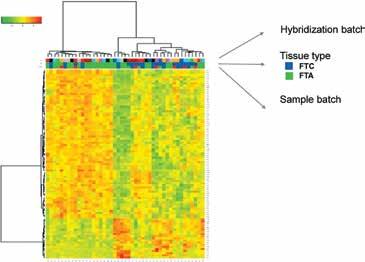 Transcriptome of follicular thyroid tumours Bartosz Wojtaś et al. A B Figure 4. Clustering of samples and genes by the gene list of transcripts correlated to the first Principal Component (PC#1). A. Clustering of the set of follicular carcinomas (FTC, blue) and adenomas (FTA, green).