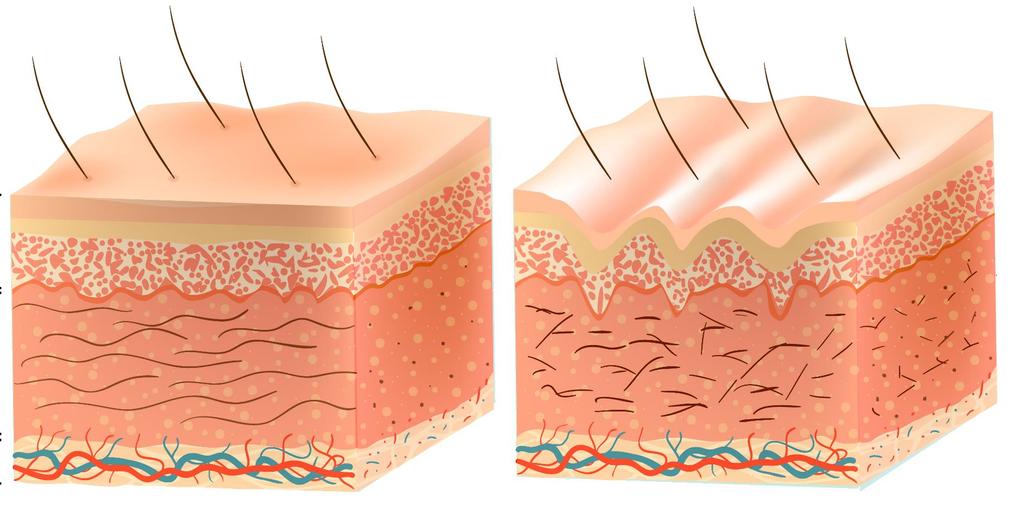 Poprawa stanu skóry przy użyciu lasera Stymuluje produkcję kolagenu