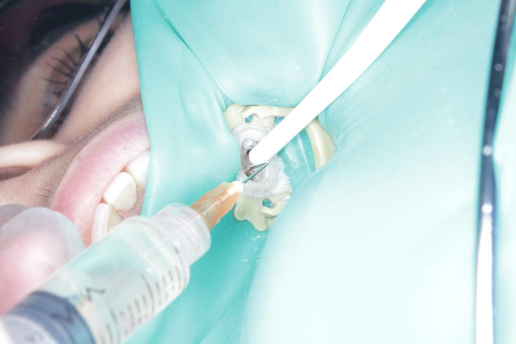TEXT PO NIEWIELKIM PRZEPCHNIĘCIU PODCHLORYNU PODCZAS LECZENIA KANAŁOWEGO: źródło: www.endodoncja.pl lek przeciwbólowy np.