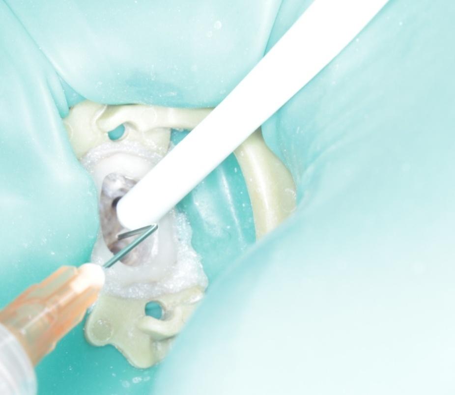 PRZEPCHNIĘCIE PODCHLORYNU ZĄB diagnostyka obfite przepłukanie solą fizjologiczną!