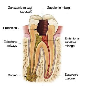 Pulpopatie nieodwracalne na tle zapalenia miazgi (pulpitis)