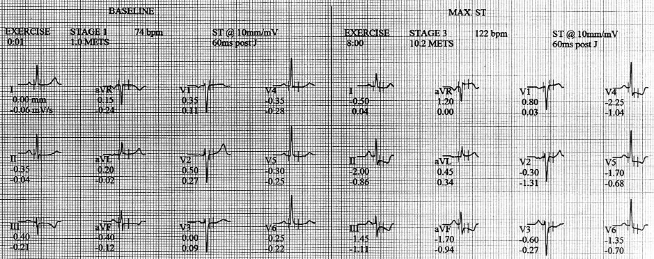 Odmienności przebiegu choroby niedokrwiennej serca u kobiet 629 Rycina 1.