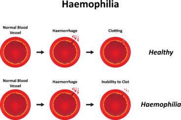 ZADANIE: U ludzi gen hemofilii (h) jest zlokalizowany w chromosomie X i występuje z częstotliwością 0,03.